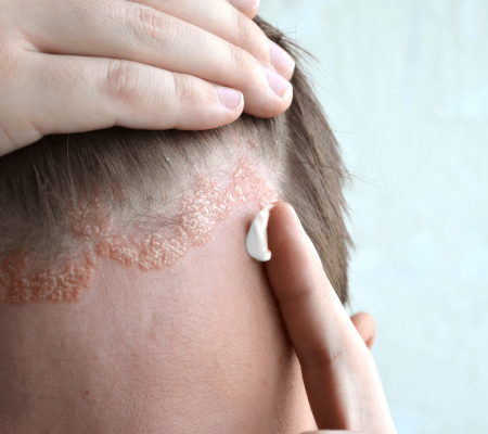 Kosmetyki na łuszczycę skóry głowy – ranking produktów